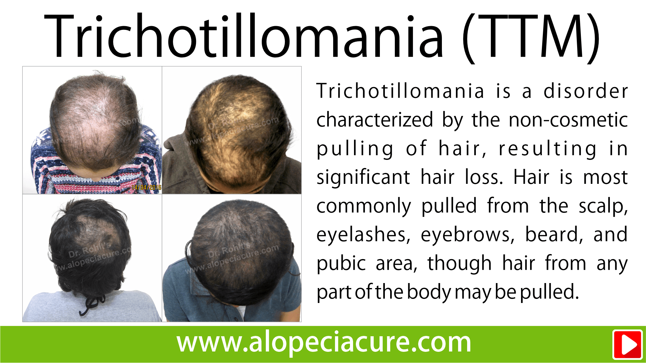 trichotillomania treatment